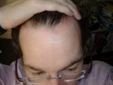 Scalp Psoriasis after